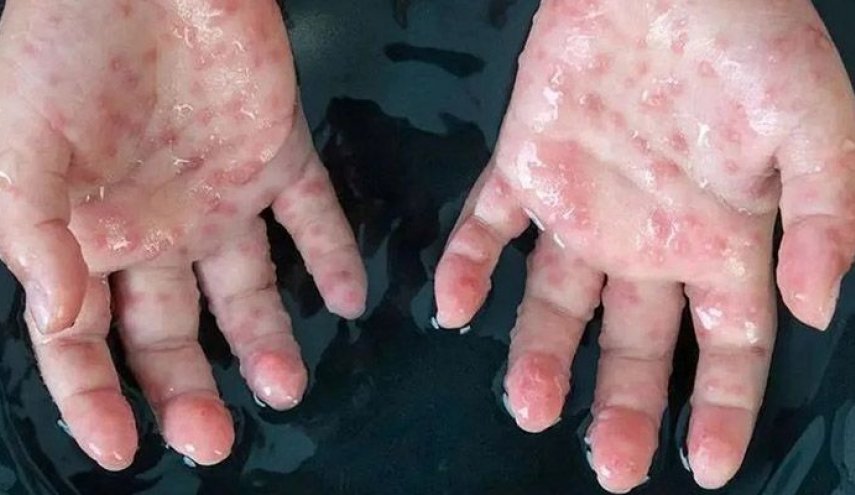 شناسایی اولین مورد ابتلا به «آبله میمون» در همسایه جنوبی ایران
