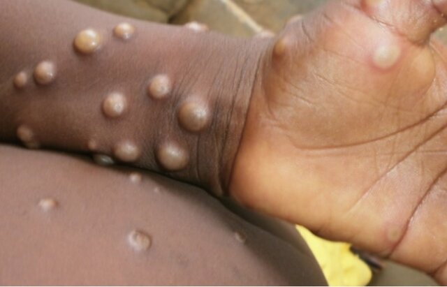 شناسایی موارد جدید ابتلا به آبله میمون در جهان/ ۳۰ مورد جدید در اسپانیا و پرتغال